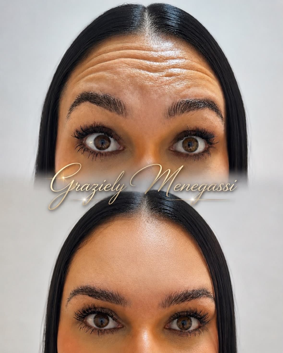 Antes e depois de aplicação de toxina botulínica na testa