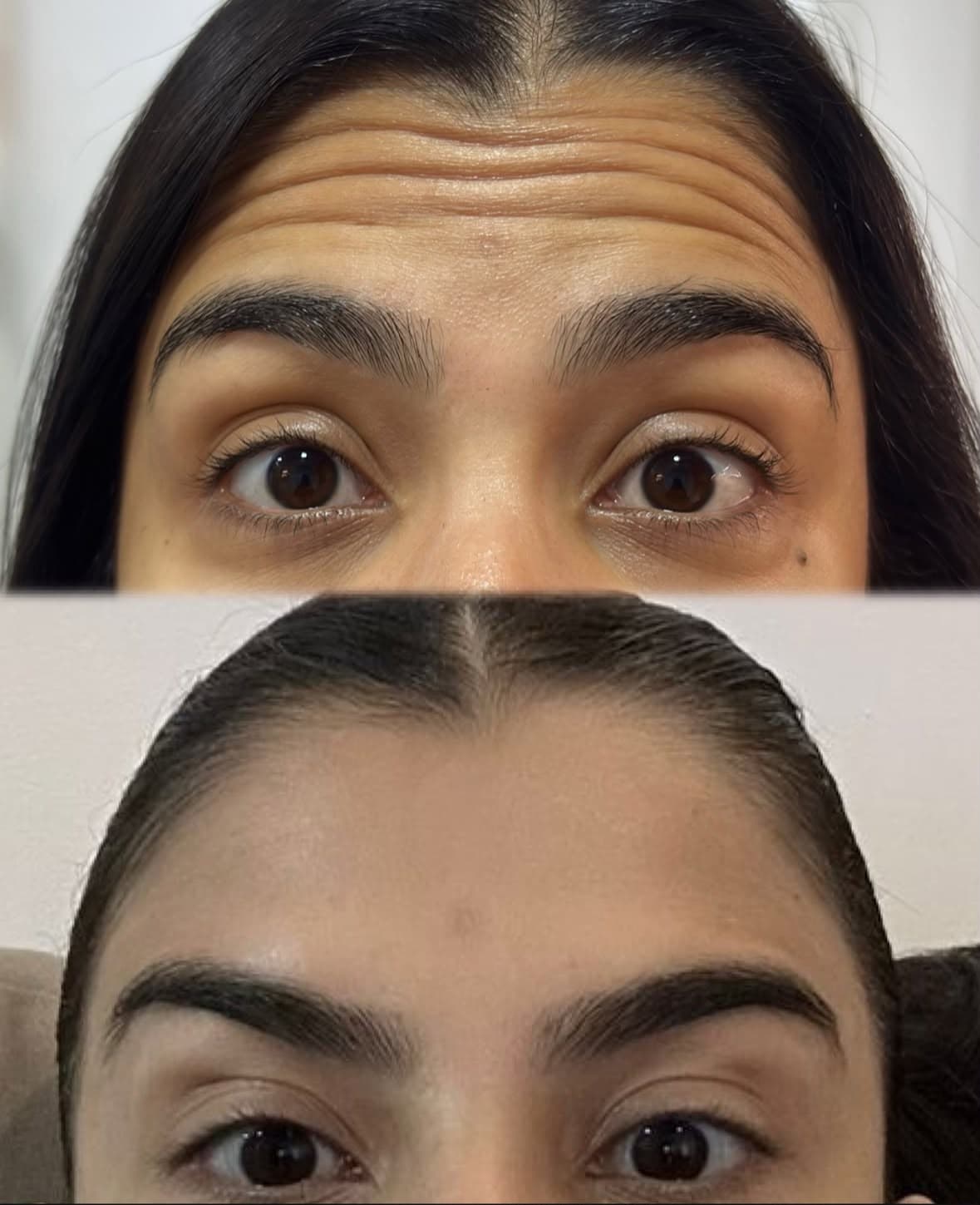 Antes e depois de aplicação de toxina botulínica na testa e glabela