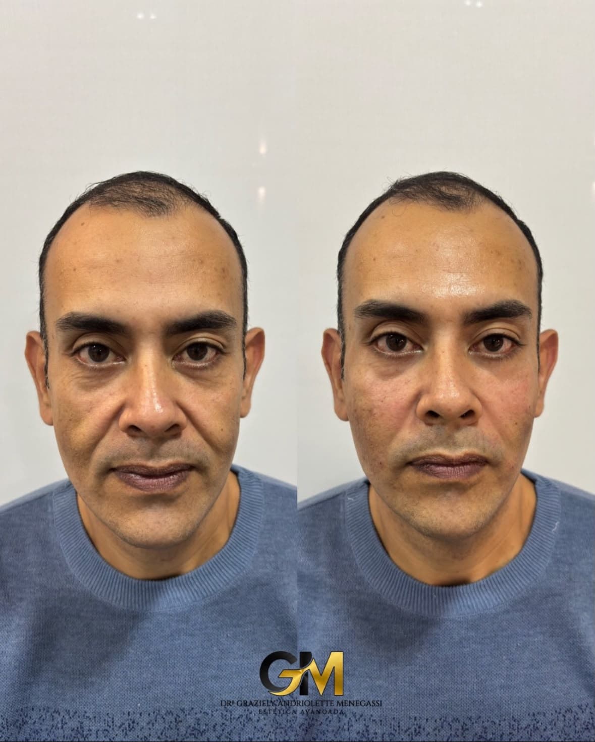 Antes e depois de harmonização facial