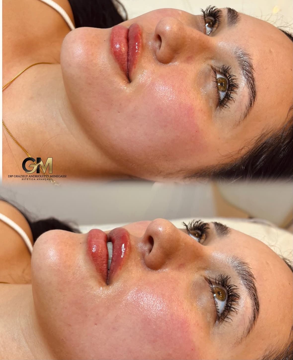 Antes e depois de preenchimento labial, foto de perfil