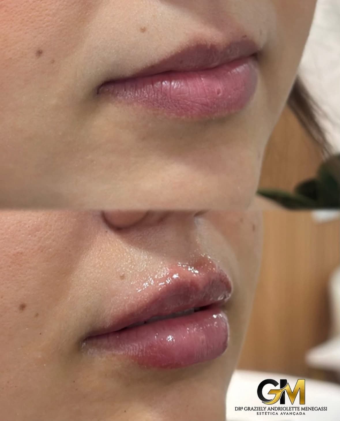 Antes e depois de preenchimento labial, foto de perfil